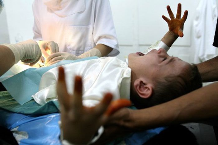 opération de circoncision